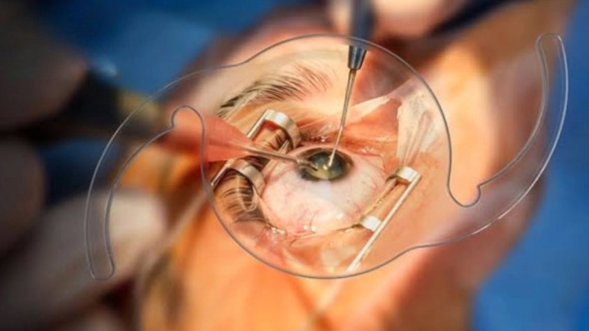 Cataract Surgery