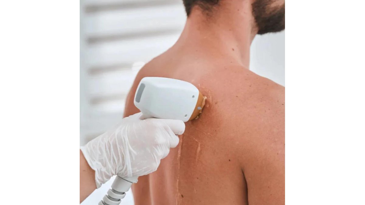 LASER HAIR REDUCTION