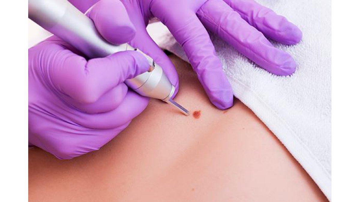 SKIN, TAGS & WART REMOVAL